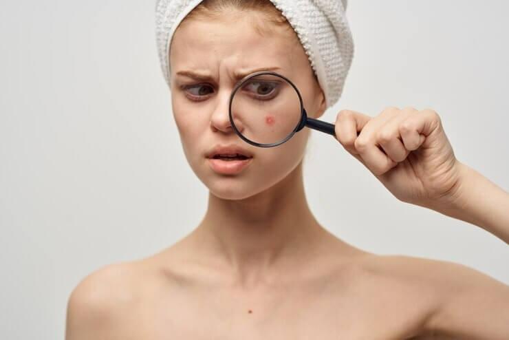 Acne vs Pimples, The Key Differences