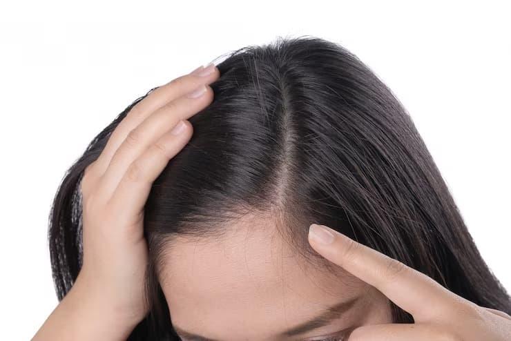 How To Stop Receding Hairline