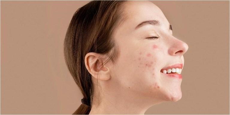 Apple Cider On Pimples