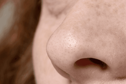 Clogged Pores