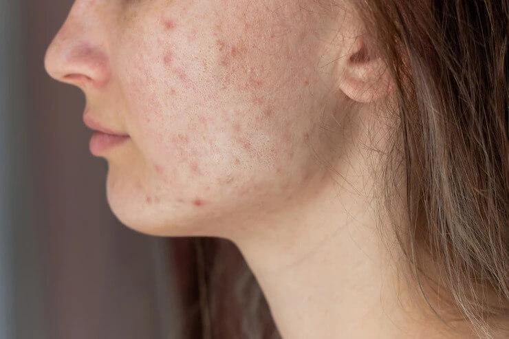 What are Acne Scars and Its Causes