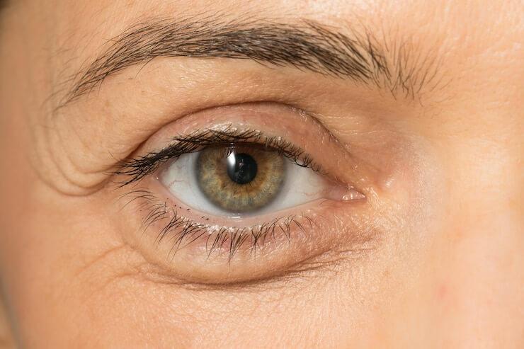 What Causes Puffy Eyes and How To Get Rid Of Under Eye Bags